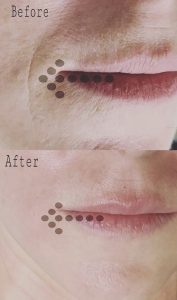 MSA Smile Lines